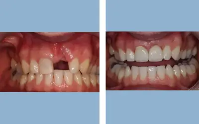 Before and After